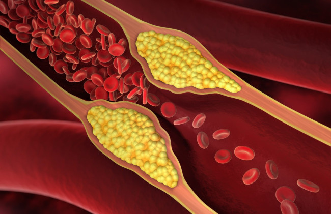 Натуральный способ снизить холестерин: простой рецепт с имбирем и чесноком
