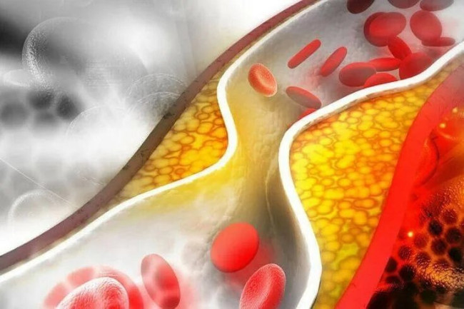 Смешайте чеснок и имбирь с уксусом: простое средство для снижения плохого холестерина