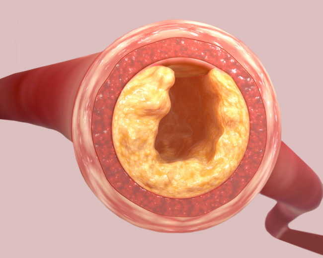 Авокадо в рационе: как снизить уровень холестерина и контролировать аппетит